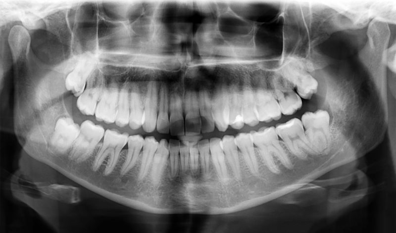 Pantomogram - na czym polega zdjęcie panoramiczne zębów