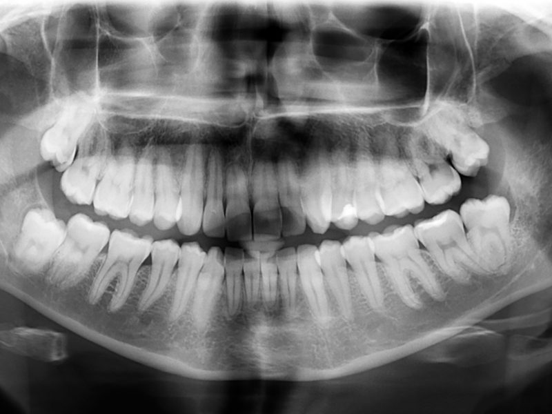 Pantomogram - na czym polega zdjęcie panoramiczne zębów