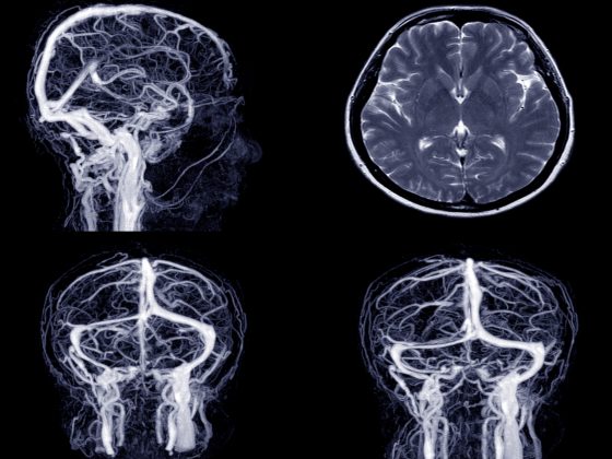 Rezonans angiografia głowy - jak przebiega, jak się przygotować