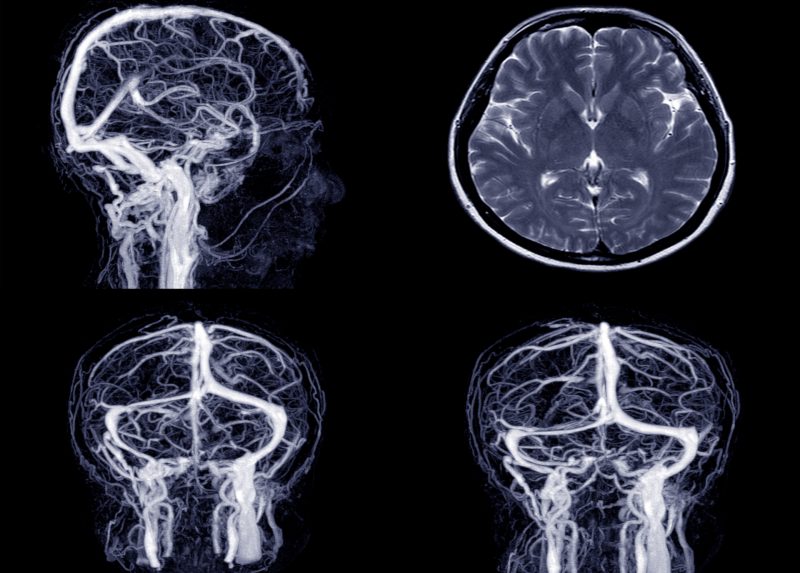 Rezonans angiografia głowy - jak przebiega, jak się przygotować