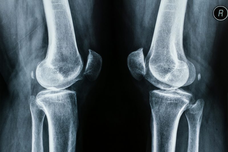 RTG kolan (rentgen stawu kolanowego) - jak przebiega, jak się przygotować